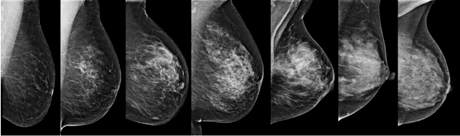 breastdensity.png
